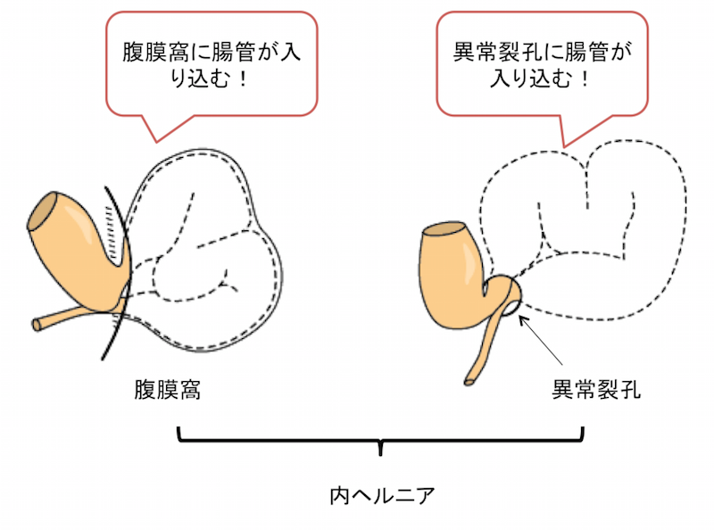 限定入荷されました 【裁断済み】腹腔内内ヘルニア大全 - 本